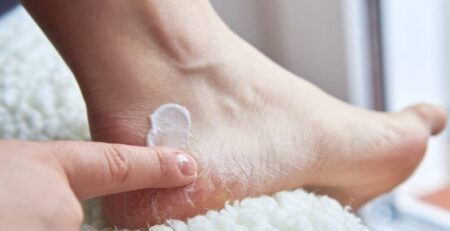 গোড়ালি ফাটা