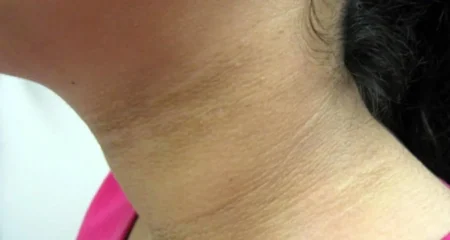 ঘাড়ের কালো দাগ