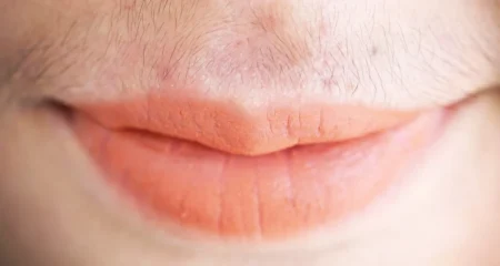 মুখের অবাঞ্ছিত লোম দূর