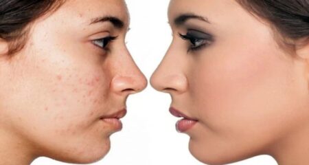 মুখের গর্ত দূর