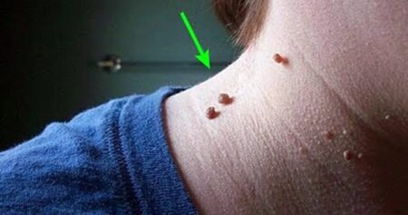 অস্বাভাবিক আঁচিল