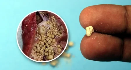 কিডনিতে পাথর