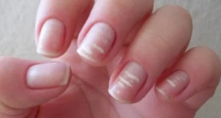 নখে-সাদা-দাগ