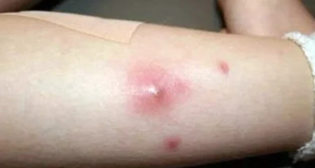 তীব্র যন্ত্রণাদায়ক বিষফোড়া থেকে মুক্তির ঘরোয়া উপায় জানুন বিষ ফোড়া