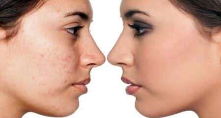 মুখের গর্ত দূর করার সহজ কার্যকরী উপায় মুখের গর্ত