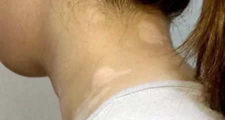 মুখের ছুলির দাগ দূর করার সহজ পদ্ধতি মুখের ছুলি