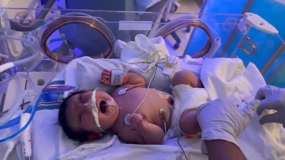 California Mother Survives Rare Abdominal Ectopic Pregnancy After Safe Delivery