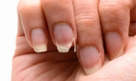 নখ ফেটে যায়