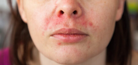 Perioral Dermatitis Triggers and How to Soothe Flare-Ups perioral dermatitis