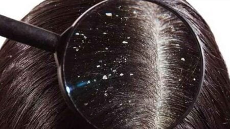 যে ভিটামিনের অভাবে শীতকালে মাথায় অতিরিক্ত খুশকি শীতে মাথায় খুশকি