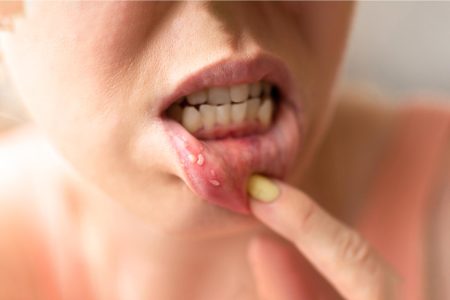 মুখে ঘা হয় কেন